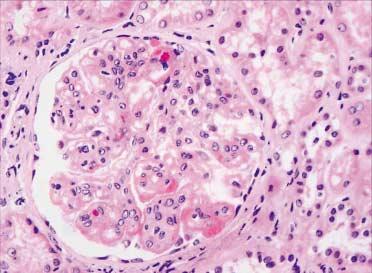 walls with wireloop lesions and hyaline thrombi. (C) Lupus nephritis, class IV-G (A/C).