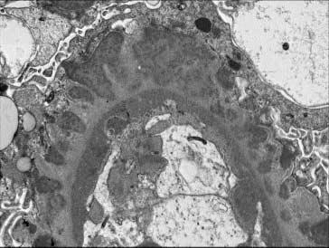 (C and D) Electron microscopic photos reveal numerous subepithelial electron dense deposits scattered along the glomerular capillary loops.