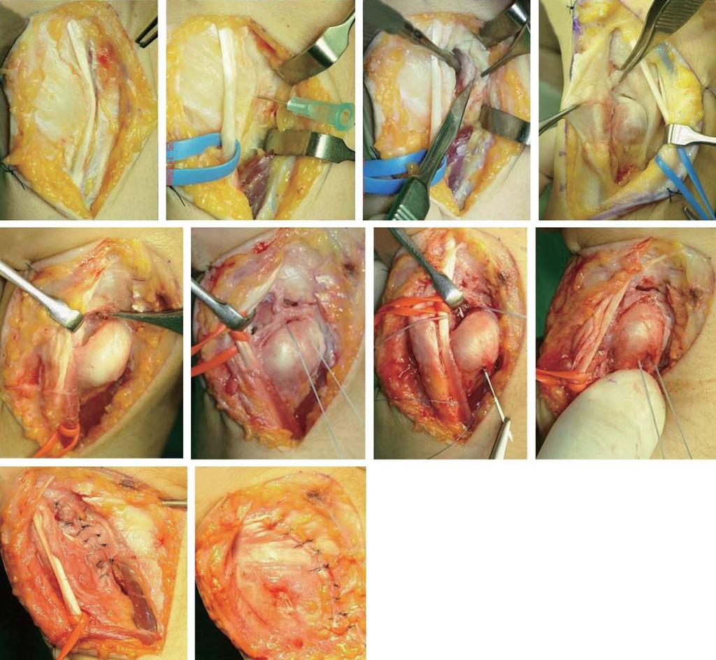 In Hyeok Rhyou, Open Repair of Triangular Fibrocartilage Complex Type 1B Tear 우수술적치료를고려하는것이좋다.