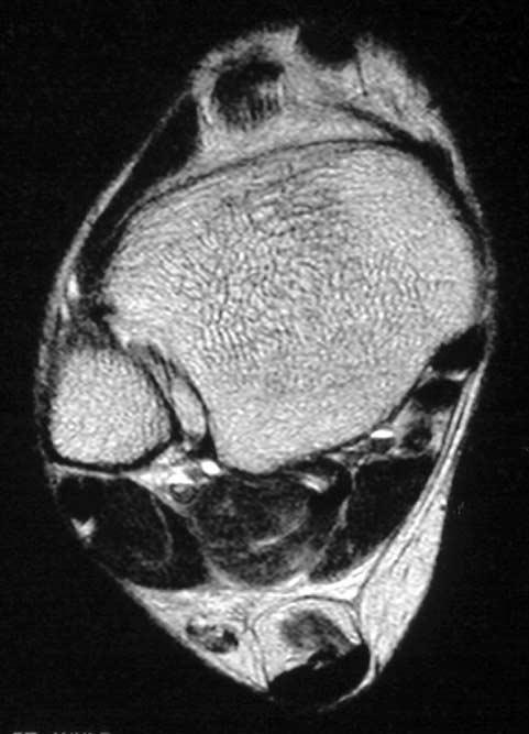 Axial T2-weighted MR image (3700/119) shows high SI in FHL muscle(arrow), representing muscle injury. 장무지굴근의건은모든환자에서정상적으로관찰되었으며, 장무지굴근의근건접합부위상방에고신호강도가 1예 (4%) 에서관찰되었다 (Fig. 1).