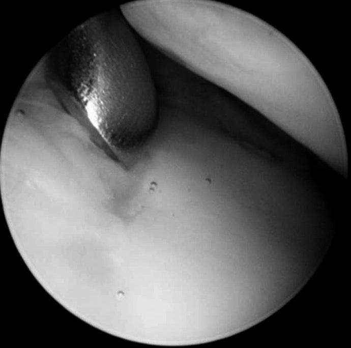 (B) This arthroscopic finding demonstrates large Os. C, calcaneus. (C) The Os is mobilized with an arthroscopic curette.