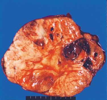 52 문경철 김종재 지제근외 1 인 Table 2. Treatment and outcome of 9 cases of undifferentiated sarcomas of the liver Case no.