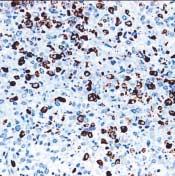 2D), 다핵거대세포와핵의심한이형성을보이는큰세포들이모든증례에서다양한정도로관찰되었다 (Fig. 2E). A B 면역조직화학염색결과 C Fig. 3. Immunohistochemical results of undifferentiated sarcoma of the liver.