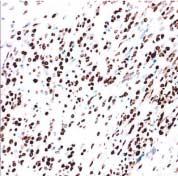 (D) Most of tumor cells show nuclear positivity for p53. 다른 1예에서는점액양기질이극히일부에서관찰되었으며주로세포밀도가높은부분으로구성되어있었다.