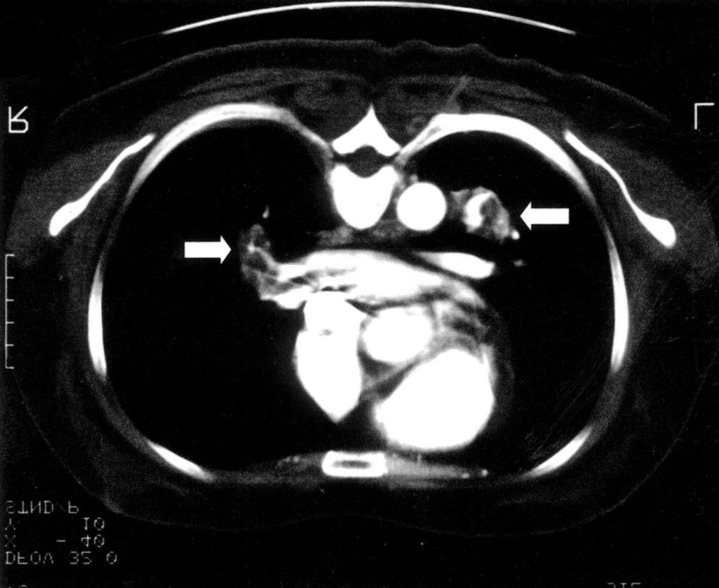 A B Fig. 2. A Dynamic chest CT showed large filling defects (arrow) in both main pulmonary arteries.
