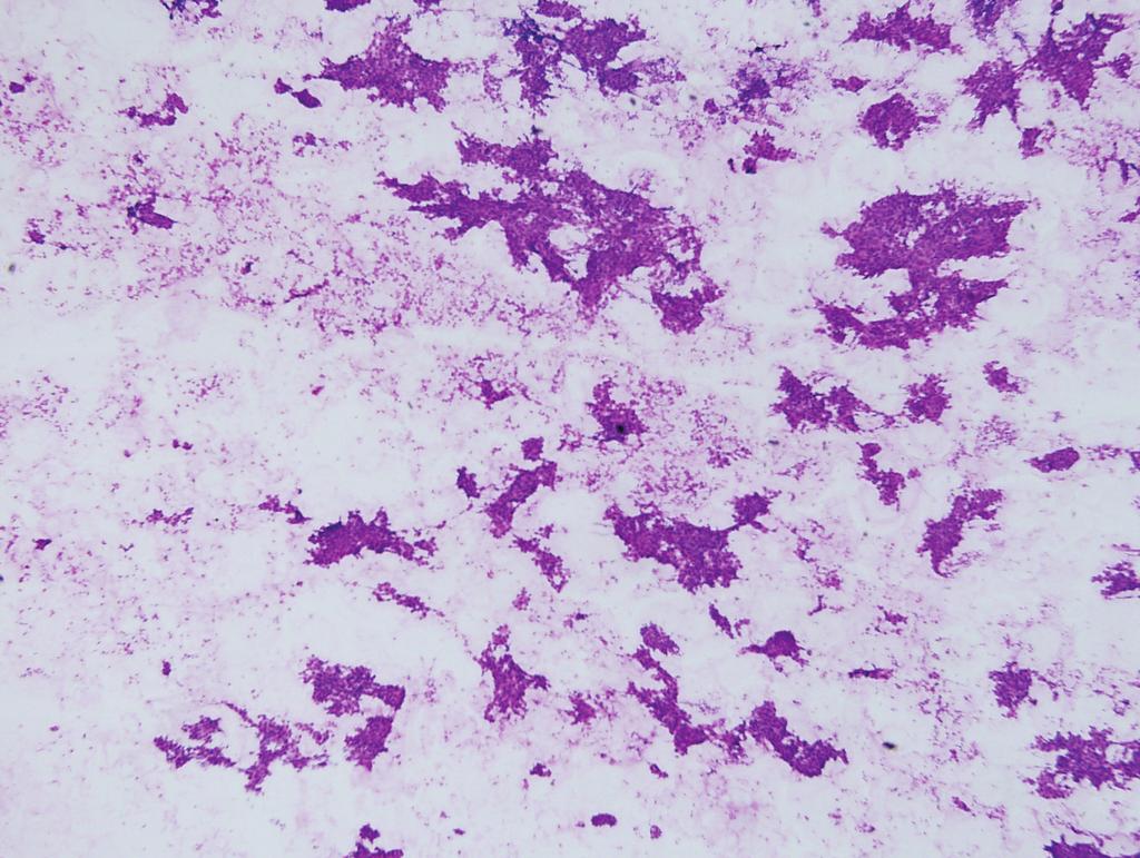 김지연 : 유방 악성 병변의 세포 소견 A B C D Fig. 1. Positive for carcinoma (ductal carcinoma). (A) The smear is hypercellular with necrotic background. (H&E).
