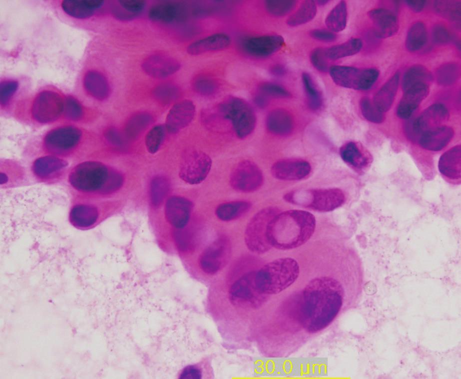 mucicarmine positive vacuoles 관세포 암종의 세포학적 소견은 종양 등급에 따라 차이 가 나며, 등급이 높을수록 진단하기는 쉽다. 세포의 형태는 염색에 양성 반응을 보인다 (Fig. 2, Table 2).