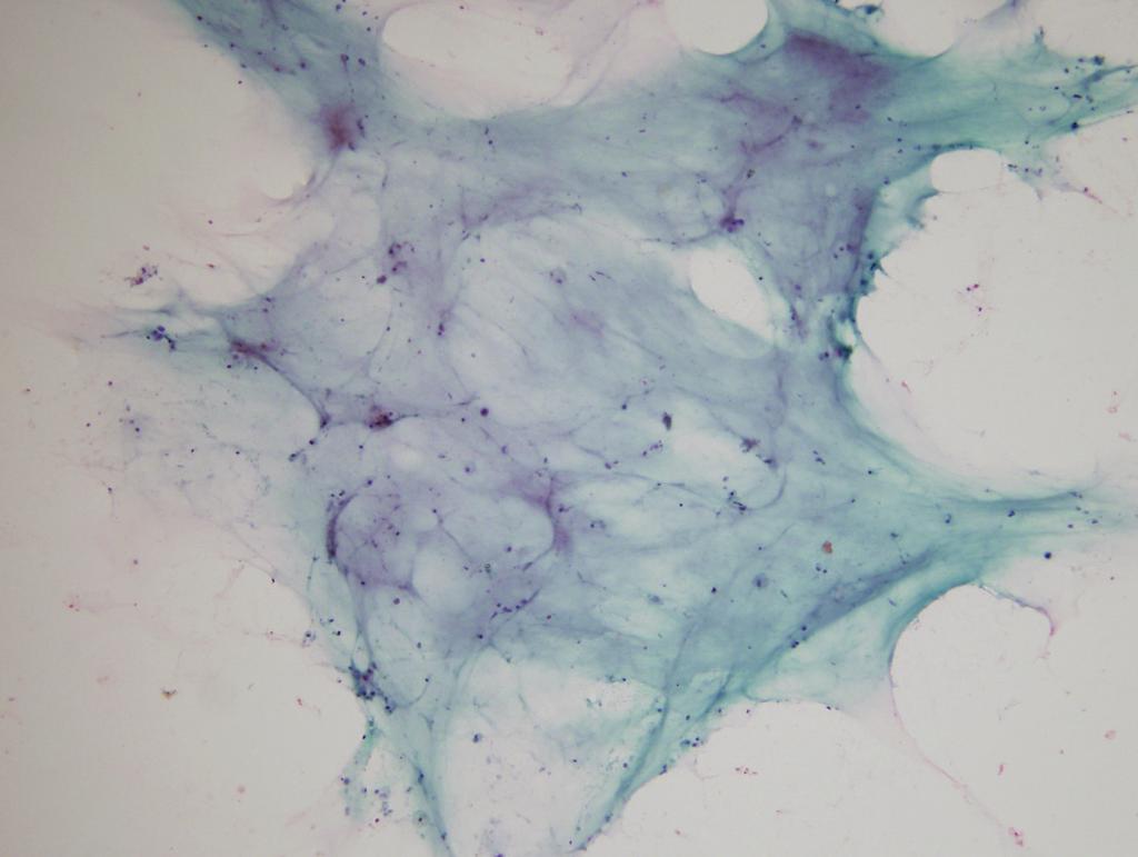 김지연 : 유방 악성 병변의 세포 소견 A B Fig 5. Mucinous carcinoma. (A) A pool of blue mucin is seen. (Papanicolaou). (B) Blood vessels and islands of tumor cells are seen in a background of mucin. (H&E).
