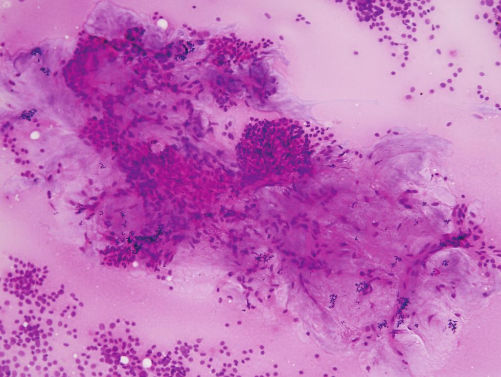29 그리 양성 아포크린 세포와는 달리 악성 아포크린 세포는 핵이 고 일반적으로 환자의 나이가 점액성 암종 환자보다 젊고 더 크고 여러 개의 큰 핵소체가 관찰된다. 세포질은 세포소견이 양성에 가까우므로 조직검사로 확진을 해야 한 Papanicolaou 염색에서는 분홍에서 회색까지 다양하게 나 다. 때로는 점액류 낭종과 점액성 암종이 동반될 수 있다.