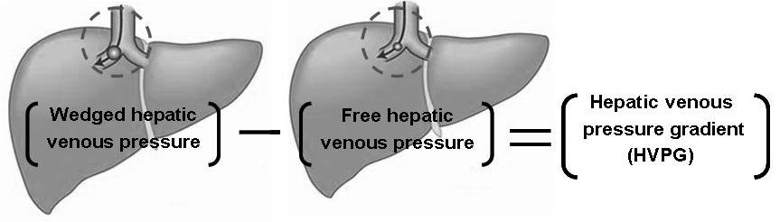- Won Hyeok Choe. Update on the treatment of portal hypertension - Figure 1. Measuring portal pressure: the hepatic venous pressure gradient. Figure 3.