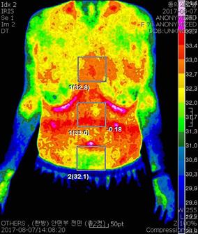 김민서 이준수 박상은 홍상훈 Fig. 3. Abd thermography. (4) 심전도소견 : (7월 31일 ) Abnormal ECG - Normal sinus rhythm T wave abnormality, consider anterior ischemia (5) 검사실소견 1 혈액검사 : (7월 31일 ) aptt 24.2 Dimer 1.