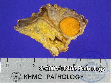 The wellmarginated circular mass is about 1cm in diameter and contains much lipid. Around the adenoma there is perirenal fat tissue. 로높아져, 수술후 40일째부터 mineralocorticoid 제제인 Fludrocortisone 0.