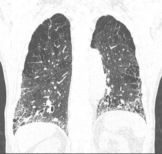 decreased volume in both lower lungs.