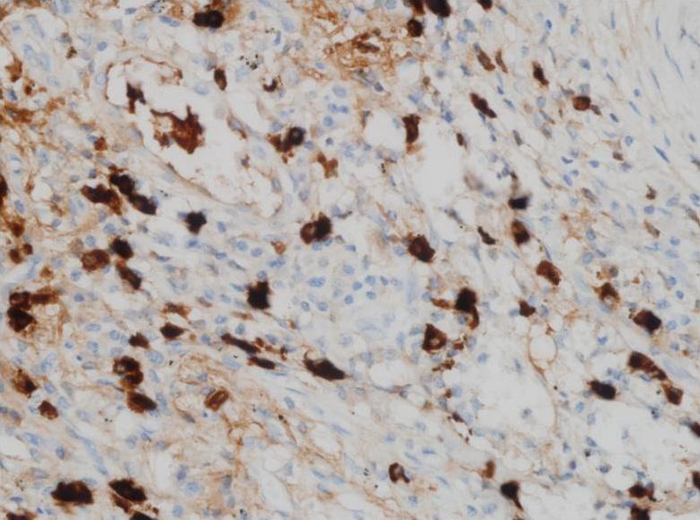 (A) A wedge resection specimen shows subpleural and septal thickening with lymphoid follicles (hematoxylin and eosin [H&E], 10).