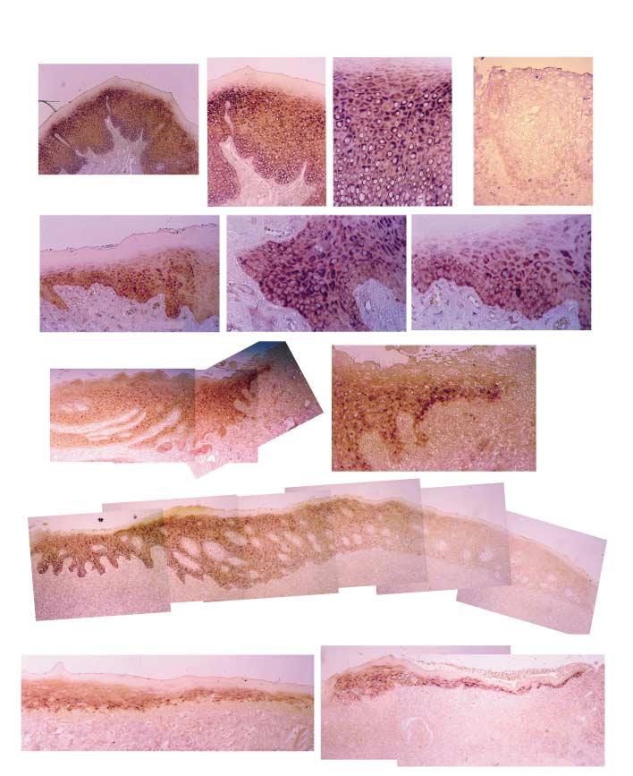 구강편평태선에서 Elafin 의단백질의발현 19 normal mucosa 1a 1b 1c sense 2 3a 3b 3c leukoplakia 4a inflammatory ulcer 4b 5 reticular type OLP atrophic type OLP 6 7 erosive type OLP Fig. 2. RNA in situ hybridization for elafin mrna.