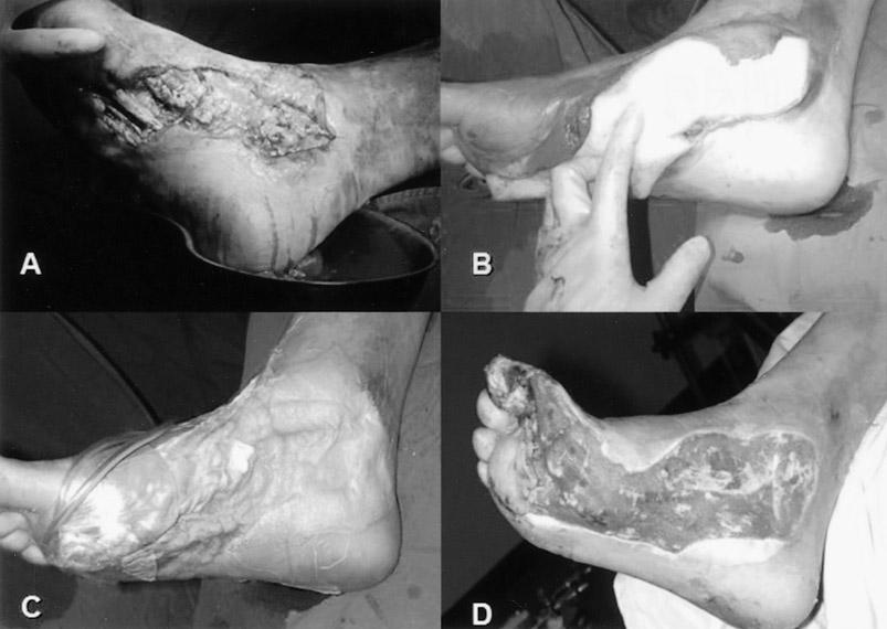 Figure 1. Photograph shows infected diabetic foot of 48-year-old man with large amount of pus (A). Sterilized sponge was cut out matched with the shape of the wound (B).
