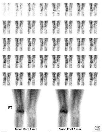 - 대한내과학회지 : 제 88 권제 3 호통권제 655 호 2015 - A B Figure 1. Three-phase bone scan. (A) Perfusion and blood pool phase.