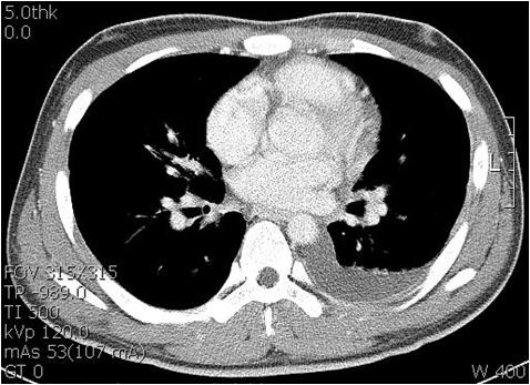 (B) Chest CT scan shows left pleural effusion with passive atelectasis with no evidence of focal leision in lung parenchyma.