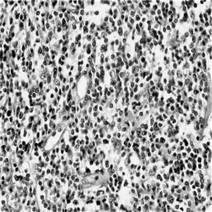 대한류마티스학회지제 17 권제 3 호 2010 Fig. 3. Histology of the nasal cavity mass.