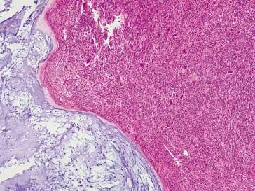 chondrosarcoma and a giant-cell rich portion resembling giant cell
