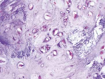 (B) Cartilaginous areas show mild nuclear pleomorphism and