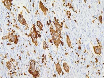 거대세포종유사역분화부분을가지는연골육종 347 A B C D Fig. 4. (A) Chondrosarcoma cells are positive for S100 protein.