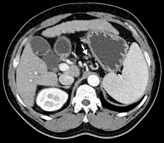 Clinicopathologic Factors Relevant to Overstaging of CT in Cases of Node Negative Early Gastric Cancer Parameter Overstaging Accurate n=42 staging p value (3.2%) n=97 (69.8%) 61±11.