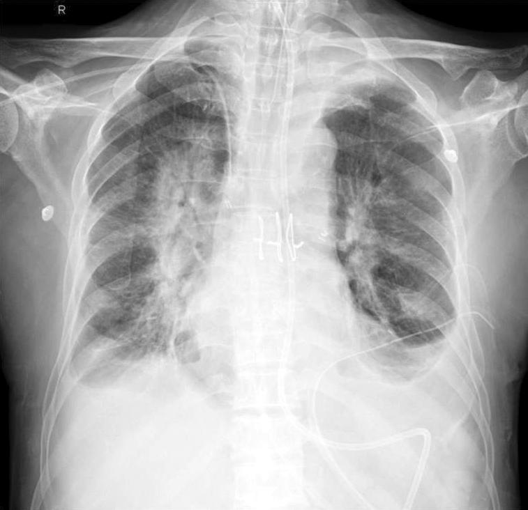 조진선 외 6인 폐이식 후 발생한 Burkholderia cepacia 폐렴 189 Fig. 1. Chest radiographs taken at 36th, 43th and 62th postoperative day.