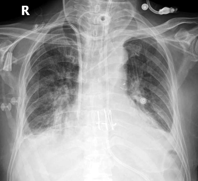 consolidations and pleural effusion. (C) Follow-up chest radiograph taken after antibiotics treatment (at 62th postoperative day) shows improvement of both lung consolidations and pleural effusion.