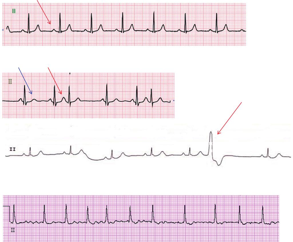 P wave 다음에일정한간격으로 QRS wave가나오는것으로보아, 방실전도 (atrioventricular conduction) 도적절한것을알수있다. Figure 1. Classification of arrhythmias. Arrhythmias can first be classified by ventricular rate.
