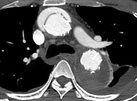 - 대한내과학회지 : 제 79 권제 3 호통권제 601 호 2010 - Removal of stent graft Figure 3.