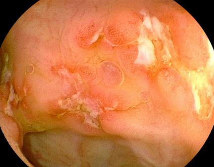 (B) There are multiple irregular-shaped ulcers with dirty exudates. Figure 2.