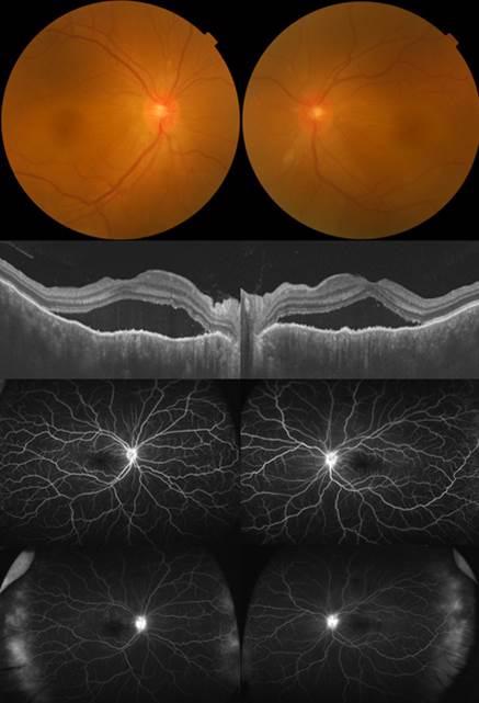 - 최민규외 : 급성폐쇄각녹내장을동반한하라다병 - A B C D E F G H Figure 3. Fundus photographs, optical coherence tomographic images and fluorescein angiographic images in both eyes.