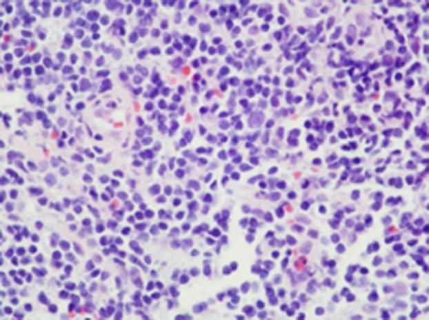Microscopic finding of small lymphocytic lymphoma (H&E stain, 400). 단과치료를하고있는바대부분의환자가 3년내에발견되어현재모두생존해있는상태다.