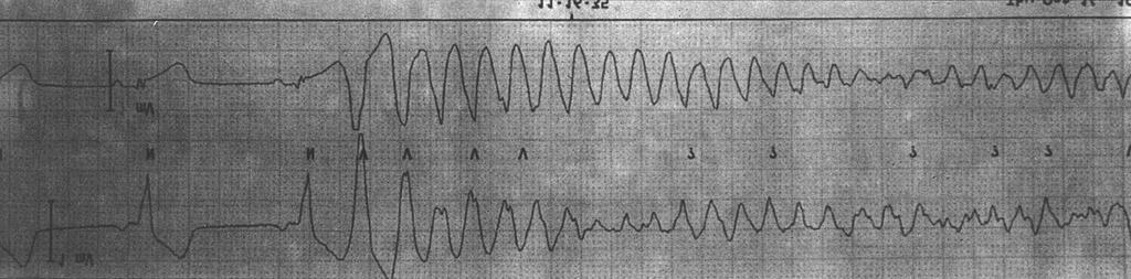 Fig. 4. The electrocardiogram with a chest pain. This electrocardiogram shows the occurrence of ventricular fibrillation after VPC on T wave of preceding sinus beat. Fig. 5.