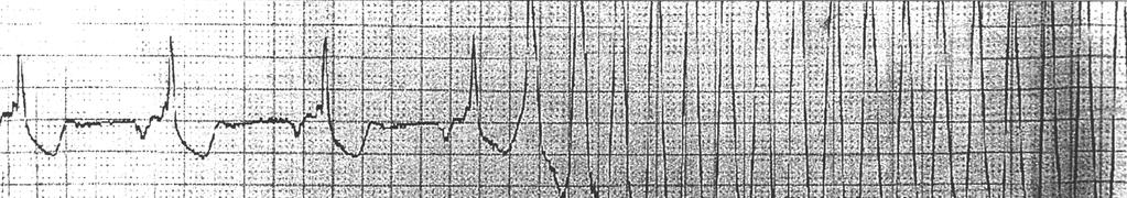 These electrocardiograms show three episodes of spontaneous fast ventricular tachycardia or ventricular fibrillation and their successful terminations by the shocks from ICD.