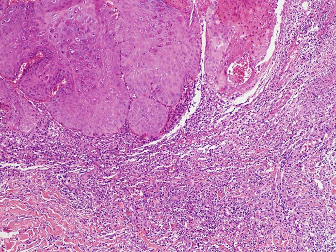 병리조직학적소견 Table 3. Involved locations of molluscum contagiosum (n=28) Locations Face & neck Trunk Extremities Genital area Number of patients Male Female Total 6 (31.6) 4 (21.1) 2 (10.5) 9 (47.