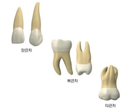 1) 치근의수에따른분류 (1) 단근치 ( 치근이 1개인치아 ) - 상, 하악전치, 상악제 1소구치를제외한소구치, 유전치 (2) 복근치