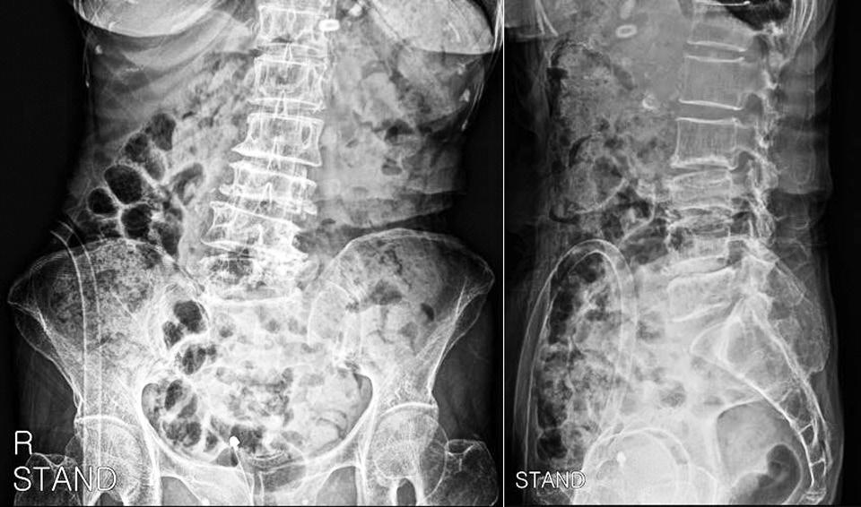 Hyoung Bok Kim et al Volume 26 Number 1 March 31 2019 Fig. 1. An X-ray showing degenerative scoliosis and compression deformity at L3. Fig. 3. The patient underwent percutaneous vertebroplasty at L3.