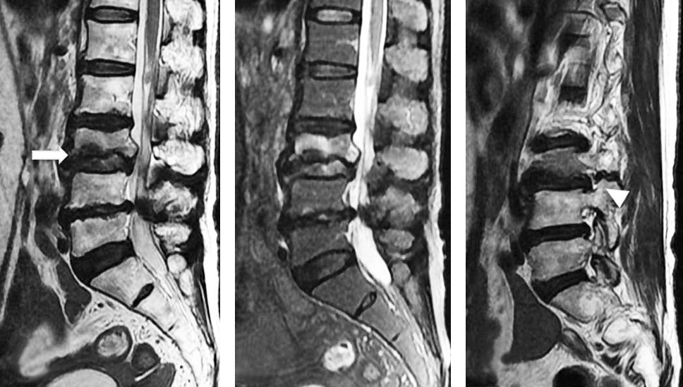 (B) A fracture fragment extending to the spinal canal was noted. (C) Severe foraminal stenosis was noted at the L3-4 right foraminal area (arrow head). A B 추제 3-4번의우측추간공부위에심한협착소견이관찰되었다 (Fig. 2C).