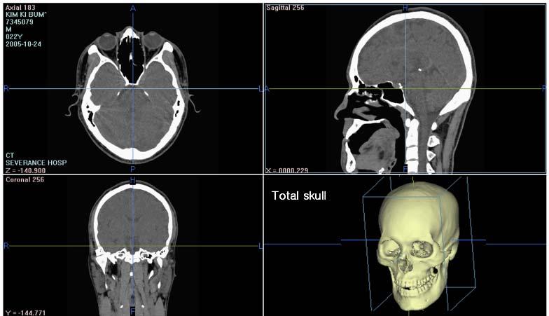 환자의두정부에서하악골하연까지포함되도록나선형 CT 를촬영하였다. axial image 의두께는 3 mm 였고, 초당 6 mm 의 table speed 로촬영하였다.