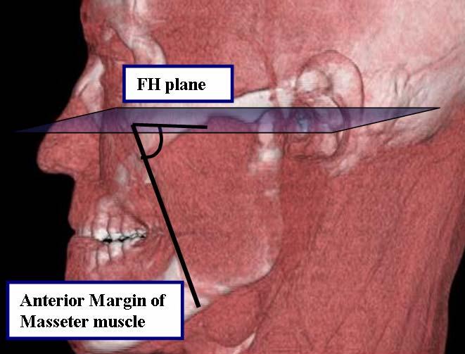 axial view of the masseter muscle and thickness of maximum cross