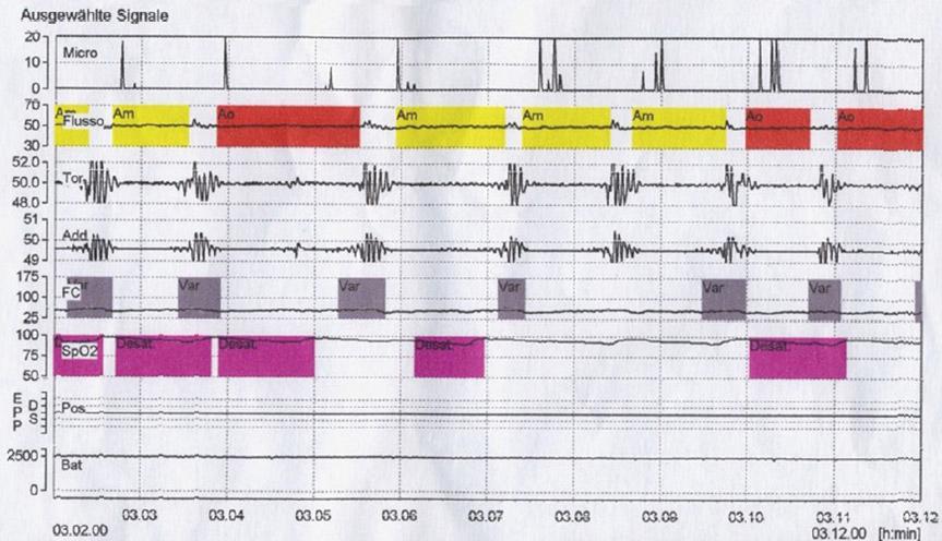 보툴리눔독소를이용한코골이및수면무호흡치료 Fig. 2.