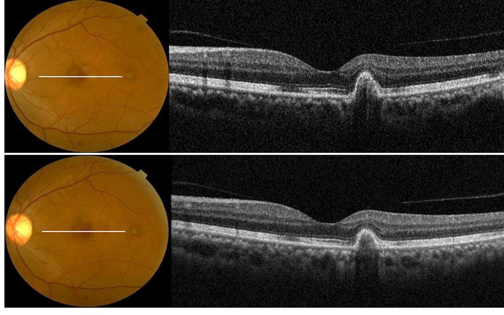 - 대한안과학회지 2014 년제 55 권제 7 호 - A B Figure 2. (A) Color fundus and spectral-domain optical coherence tomography (OCT) images of the left eye of a patient treated with a single bevacizumab injection.