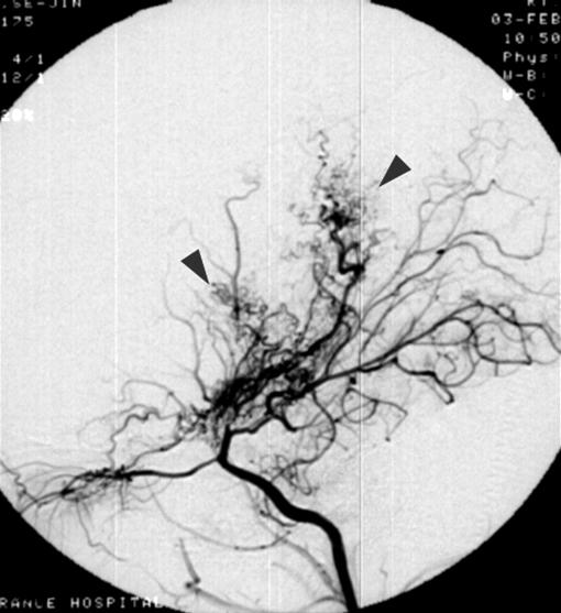 Initial angiography (A) shows mild stenosis in terminal portion of internal carotid artery and well visualized middle cerebral artery.