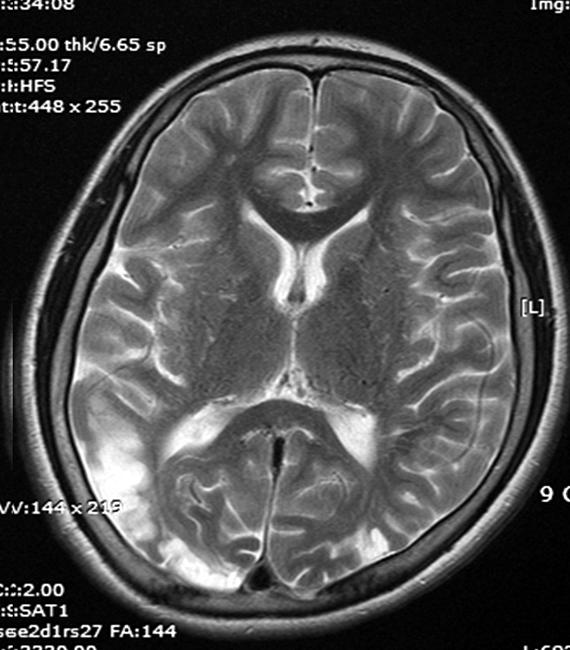 An axial T1 weighted image (B) demonstrates multiple signal voids of the hypertrophied moyamoya collateral in the basal ganglia.