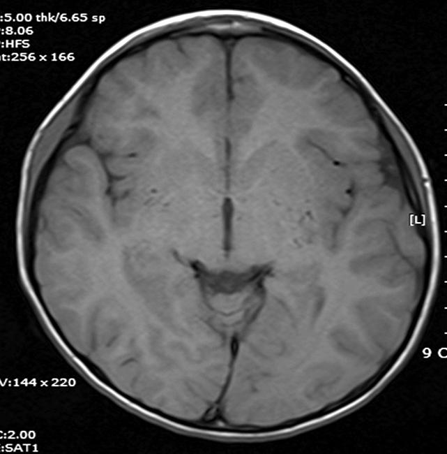 SPECT는 국소 뇌혈류를 알 수 있고, acetazolamide 정맥 주사 전후를 비교하면 혈류 예비능(vascular reserve)을 측정할 수 있다(Fig. 4) [22].