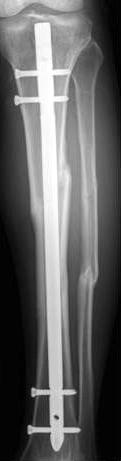 in the proximal portion of segmental tibia fracture.