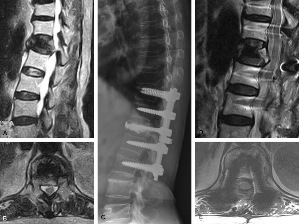 Journal of Korean Society of Spine Surgery Tardy Spinal Cord Compression after Kyphoplasty Fig. 3. (A,B) Weighted MR show suspected compression of conus medullaris by cement-augmented vertebral body.