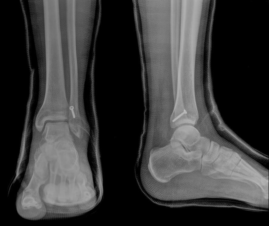 20 2 MM 14 15 66/M -3.41 2 15 * BMD, Bone marrow density; MM, Medial malleolar fracture; PM, Posterior malleoalr fracture; Deltoid, Deltoid ligament rupture; Syn, Syndesmotic injury. A B Figure 1.